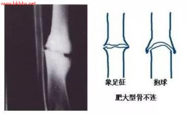 骨折几个月能走？骨折不愈合了再难行走，还好能治？