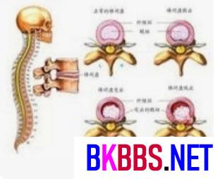 坐骨神经痛的锻炼方法