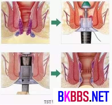 痔疮外痔肉球怎么消除用什么药