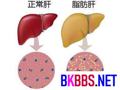 治疗脂肪肝最佳方法