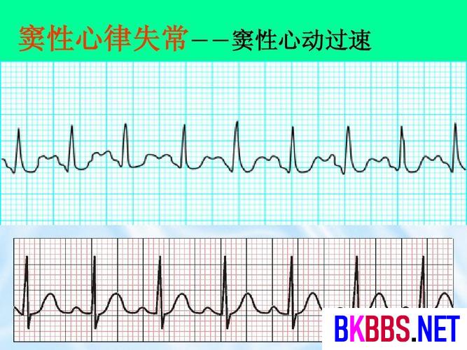 窦性心律不齐是什么意思？严重吗？