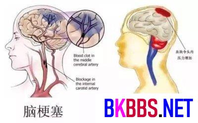 脑梗的症状都有哪些前期症状