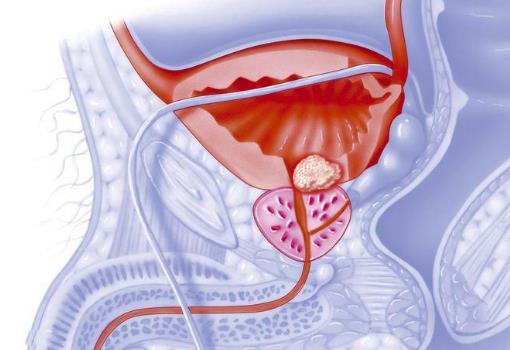 男人冬天容易得前列腺炎的原因 冬天保养尤其重要