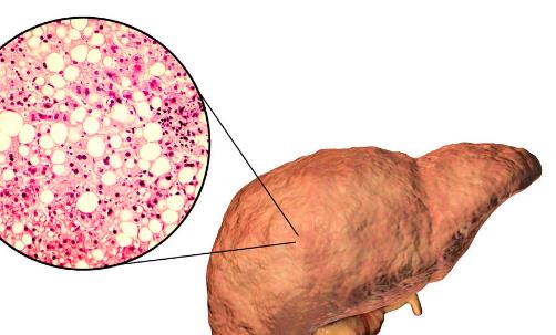 脂肪肝患者饮食禁忌有哪些 预防脂肪肝的食物要多吃