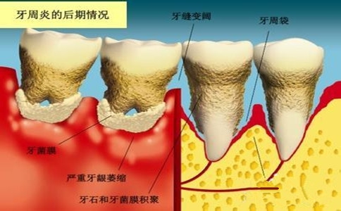 牙周炎