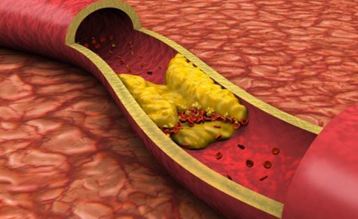 血管变硬竟然是猝死的信号 3步做好动脉硬化的防治
