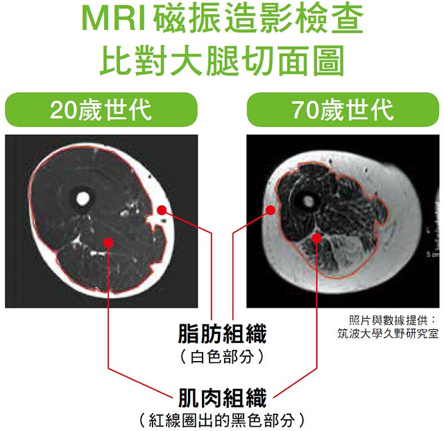 MRI磁振造影检查比对大腿切面图