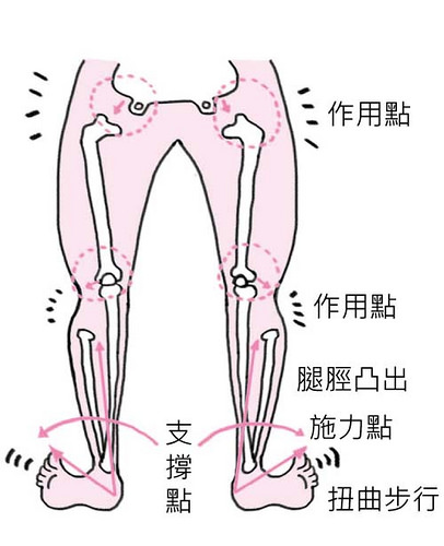 O型腿