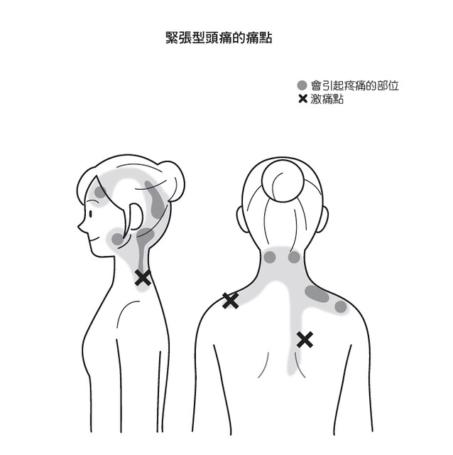 紧张型头痛的痛点