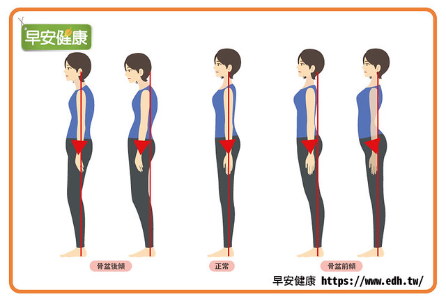 造成骨盆前倾、骨盆后倾的原因是骨盆平衡崩坏了！