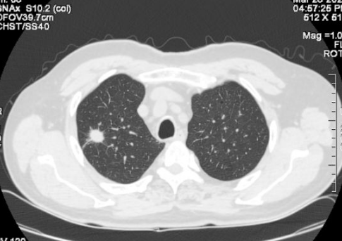 肺结节10个人9个人有吗真的吗2