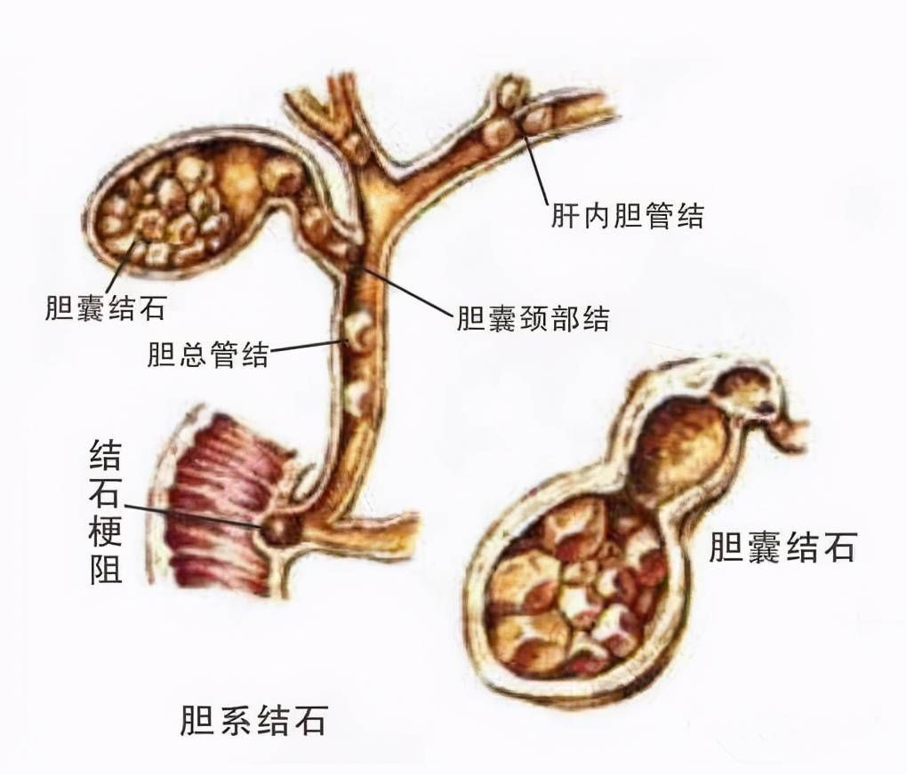 干货！肝内胆管结石术后护理要注意哪些？