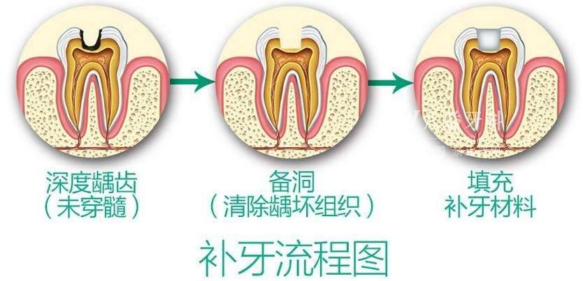 牙齿龋坏究竟要怎么办，补牙之后又能用多久呢？听听看牙医怎么说