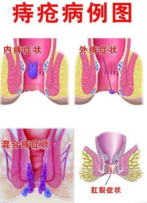 痔疮病例图