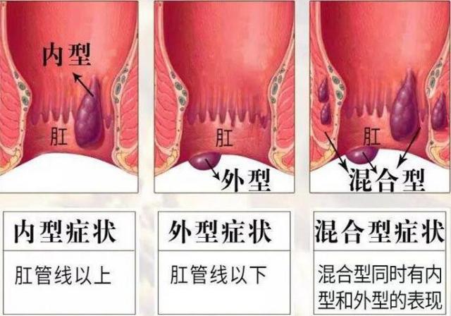 痔疮图片