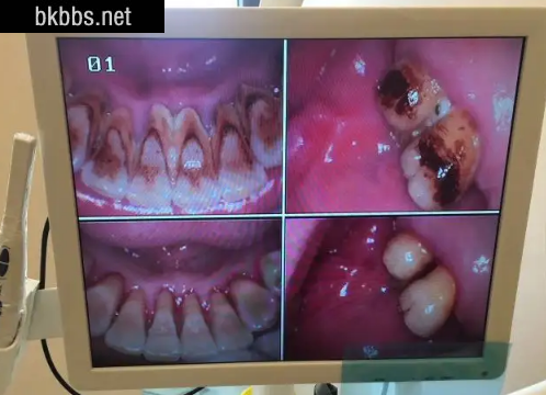 牙结石0度到3度的图2