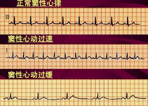 窦性心律不齐是心脏病早期吗2