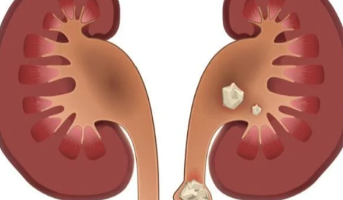 肾结石3mm×3mm多大2