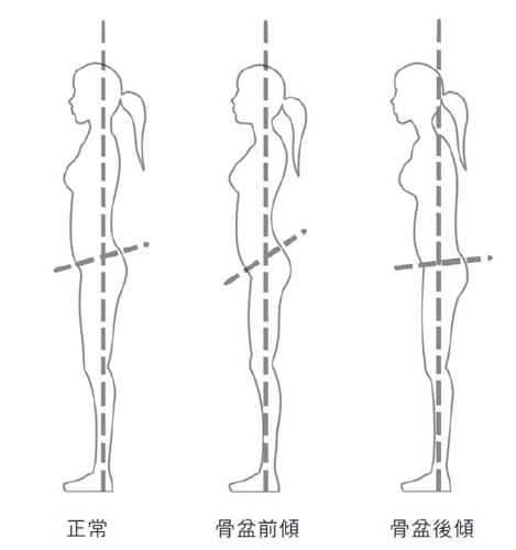 骨盆前倾,骨盆后倾,骨盆歪斜