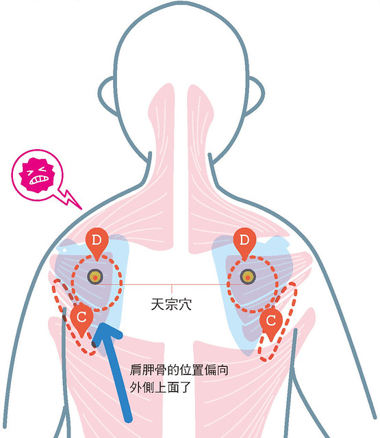 颈部至肩膀的不适：摩擦肩胛处，调整高低肩问题