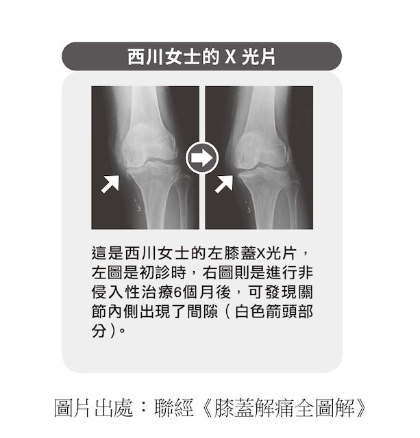 西川女士X光片