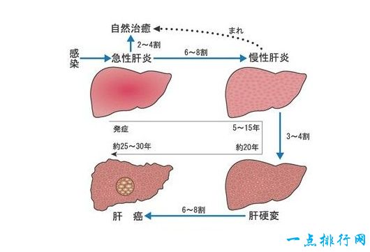 得了肝炎就会变成肝癌