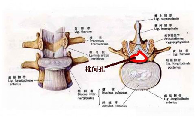 椎间孔狭窄