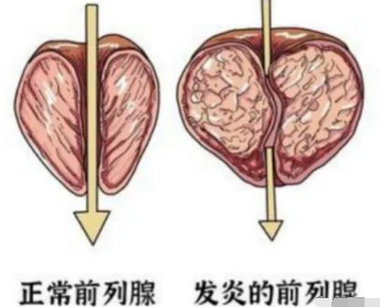 前列腺会影响男性性功能吗